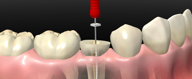 Endodoncia