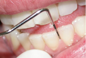 Periodoncia