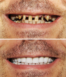 Rehabilitación oral